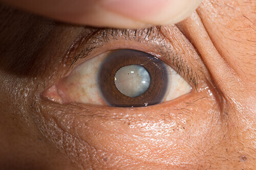 白内障の目の写真