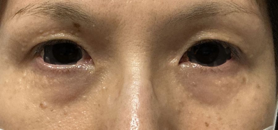 目の周りのイボをきれいに取りましょう