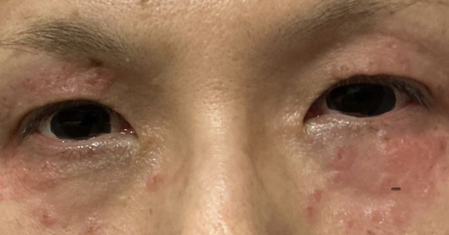 目の周りのイボをきれいに取りましょう