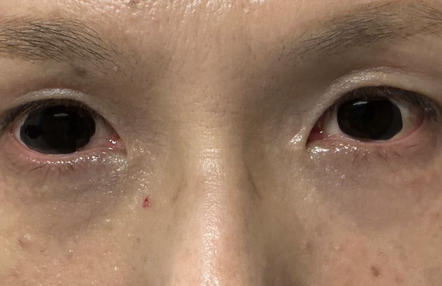 目の周りのイボをきれいに取りましょう