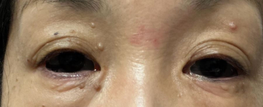 目の周りのイボを綺麗にしましょう②