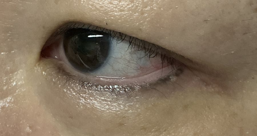 アートメイクのアイライン除去