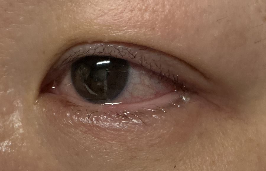 アートメイクのアイライン除去