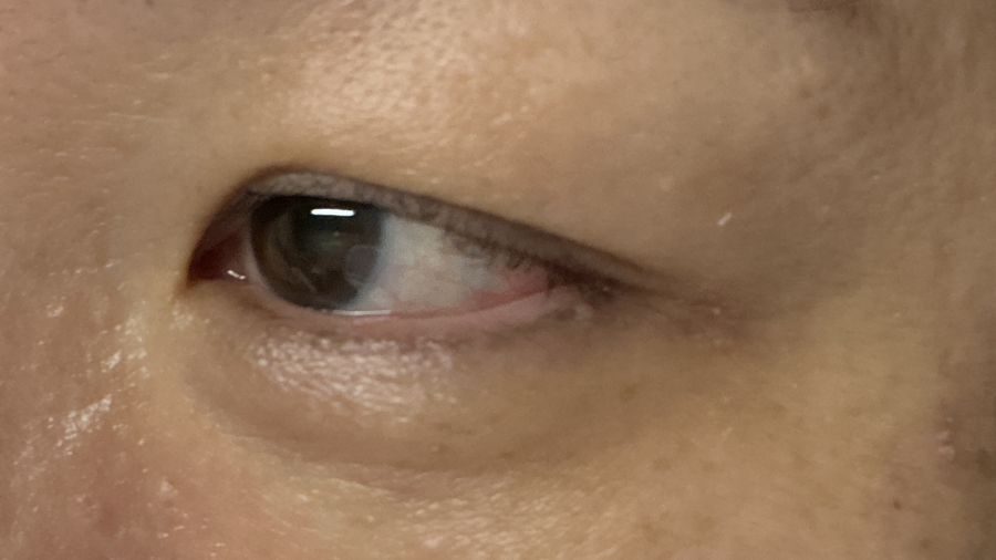 アートメイクのアイライン除去