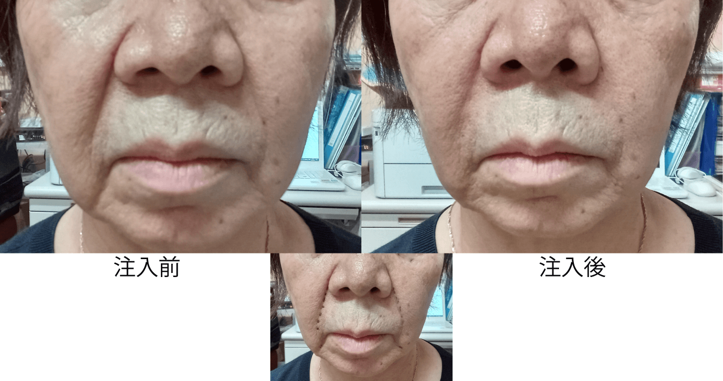 ほうれい線ヒアルロン酸注入前後写真