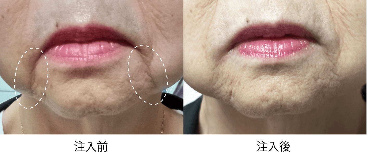マリオネットラインへのヒアルロン酸注入前後写真