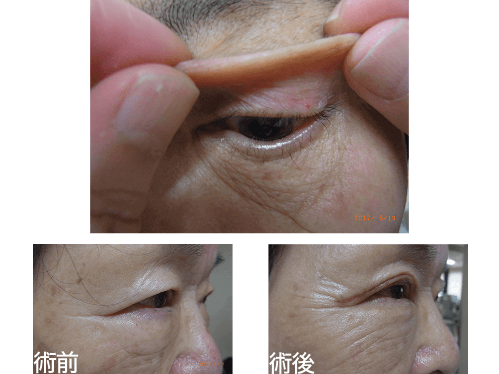 眼瞼下垂の余分な皮膚の写真
