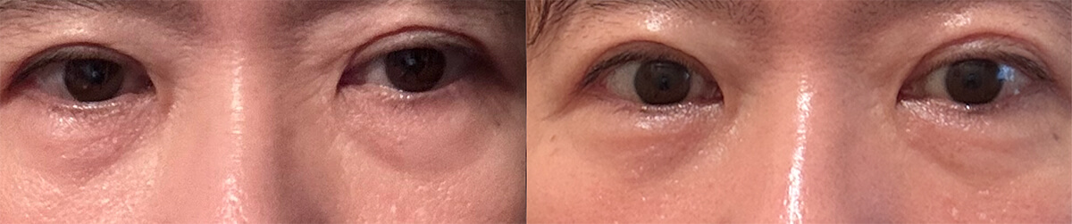 目の下・上頬へのリジュラン注入前後写真