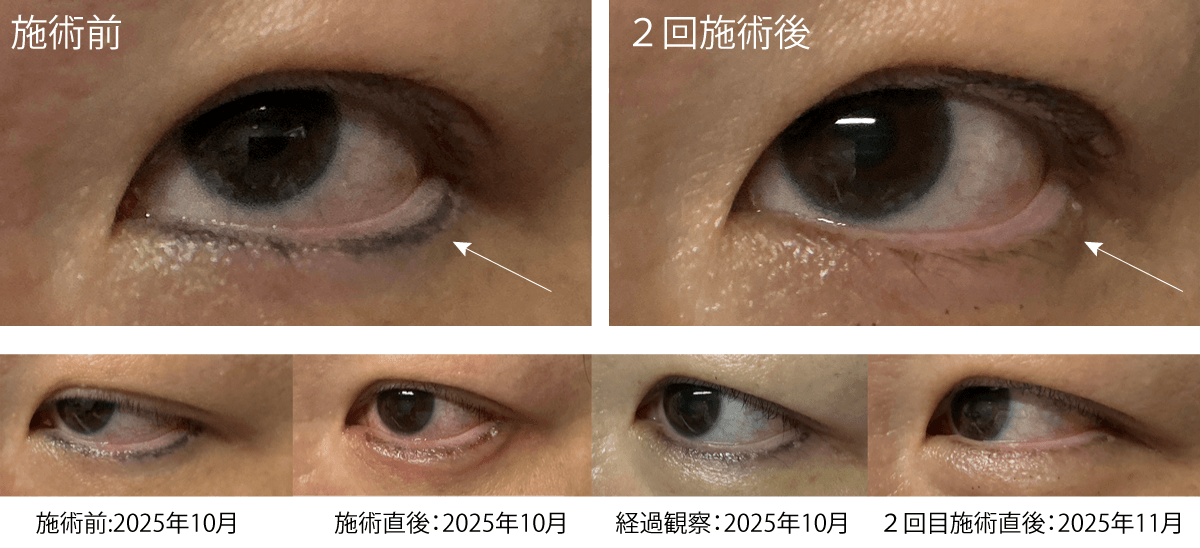 アートメイク アイライン除去レーザー前後写真