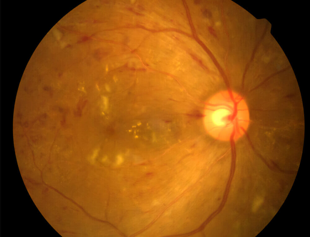 糖尿病網膜症の眼底写真